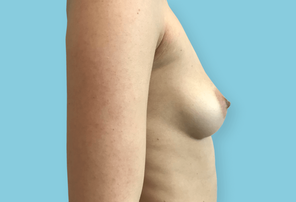 Asymetria piersi. Symetryzacja piersi protezami okrągłymi 375ml, 355ml