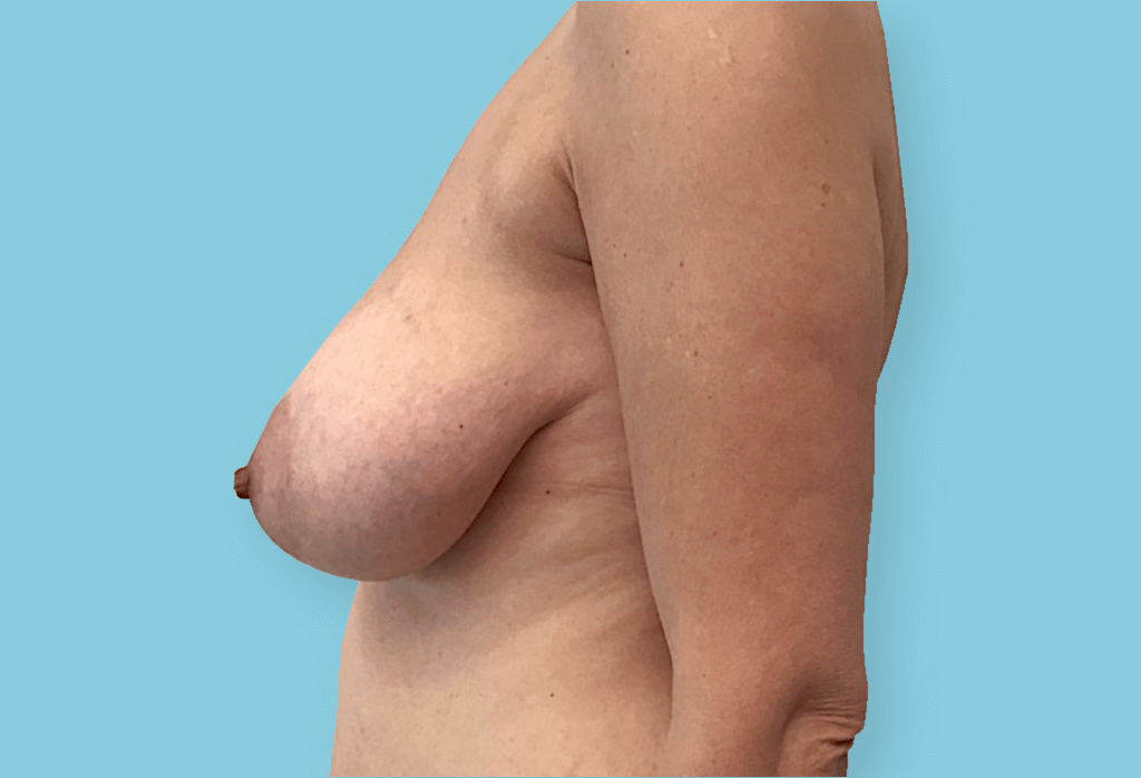 Obustronne podniesienie piersi z redukcją celem symetryzacji