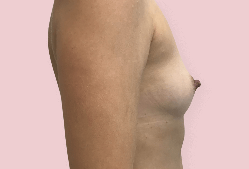 Rekonstrukcja piersi (powiększenie) protezami anatomicznym 280 cc.