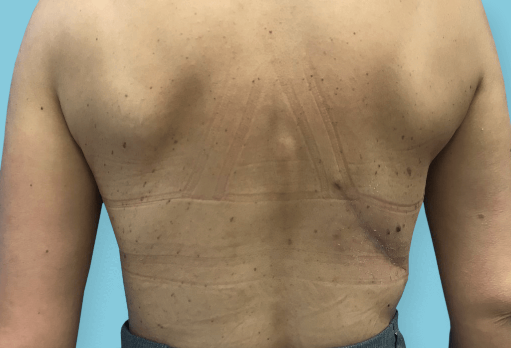 Rekonstrukcja piersi płatem LD z pleców i protezą z symetryzacją piersi lewej przez podniesienie piersi