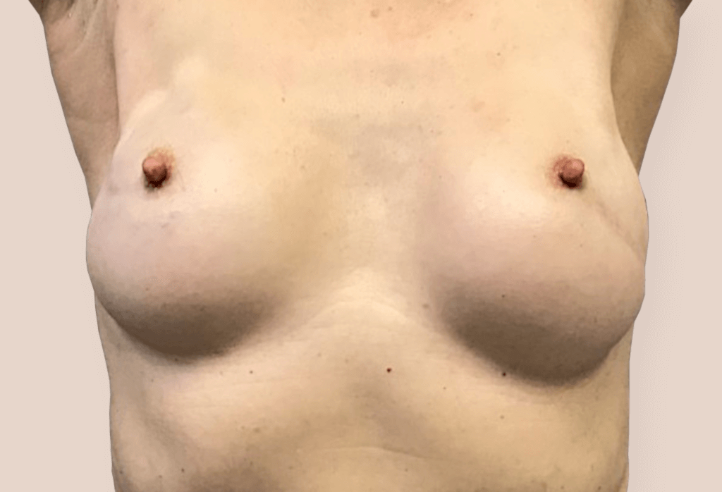 Obustronna amputacja piersi