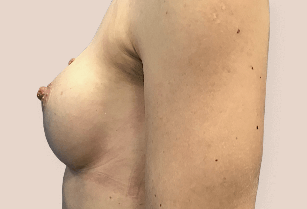 Rekonstrukcja po porodowym zaniku piersi, blizny w fałdzie podsutkowym