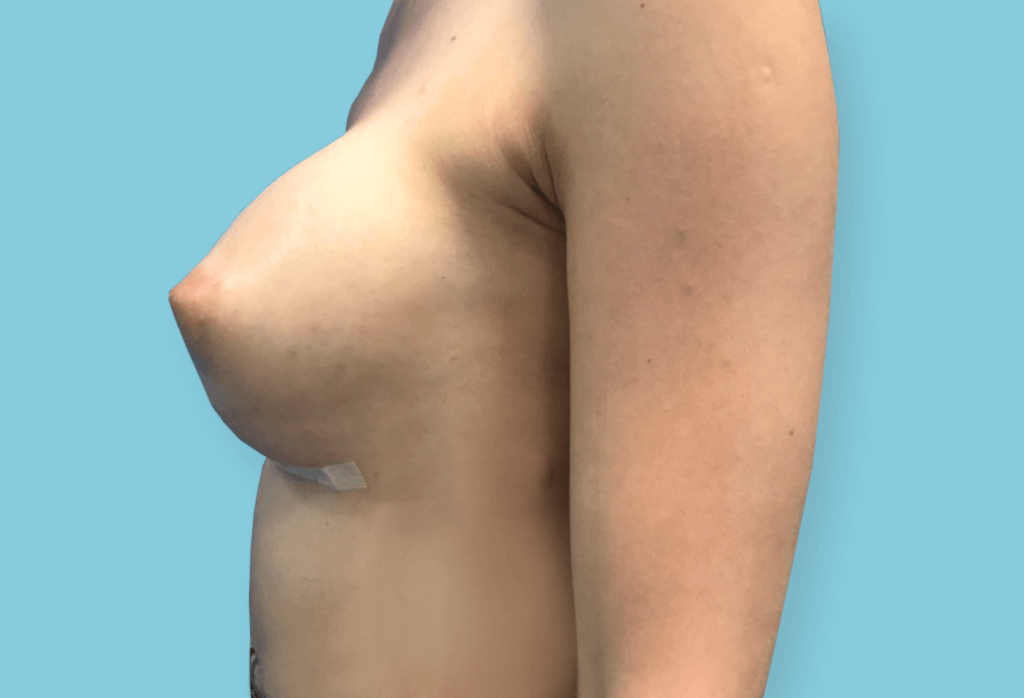 Symetryzacja piersi