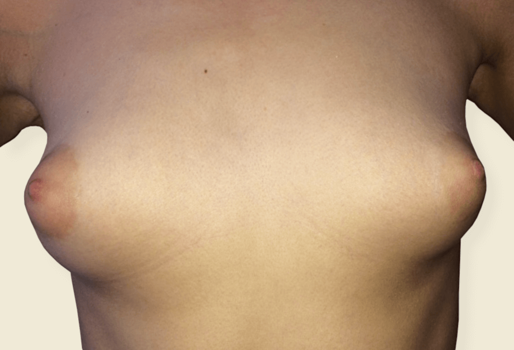 Leczenie piersi tubularnych - bulwiastych przy użyciu protez i plastyki brodawek oraz lipomodelingu