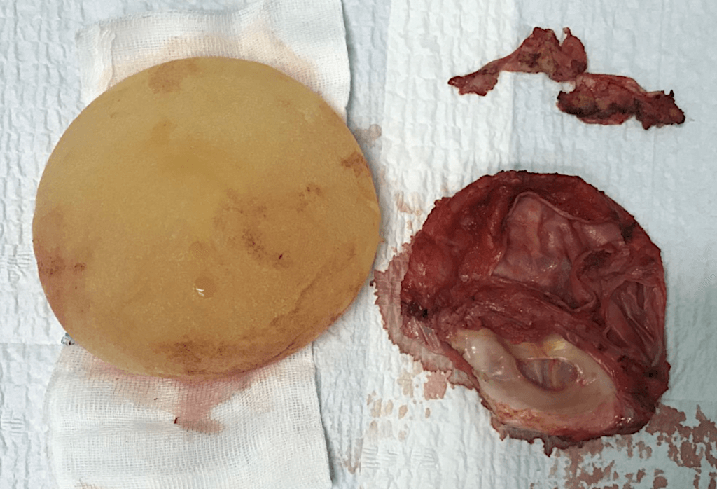 Usunięcie implantów razem z torebką włóknistą i jednoczasowa rekonstrukcja protezami anatomicznym 235