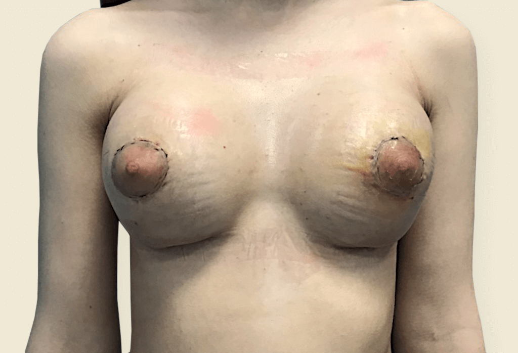 Piersi tubularne (bulwiaste) — rekonstrukcja piersi protezami okrągłymi 205cc, plastyka brodawek sutkowych z redukcją “wewnętrznego” pierścienia