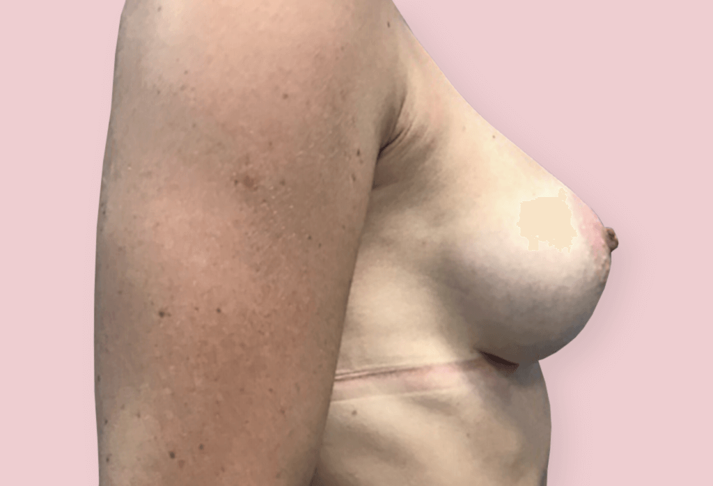 Powiekszenie piersi - wycięcie guza piersi lewej z jednoczasowa rekonstrukcją protezami anatomicznym 325