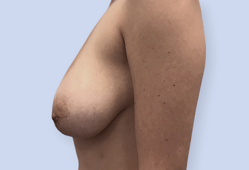 Zmniejszenie z podniesieniem piersi na szypule centralno-przyśrodkowej