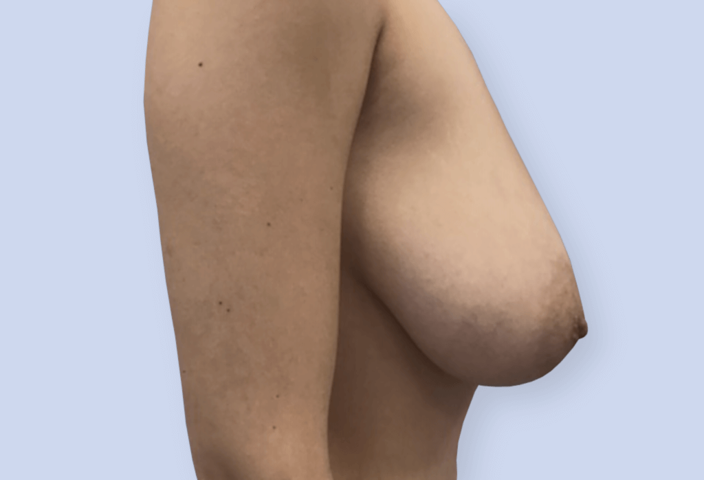 Zmniejszenie z podniesieniem piersi na szypule centralno-przyśrodkowej