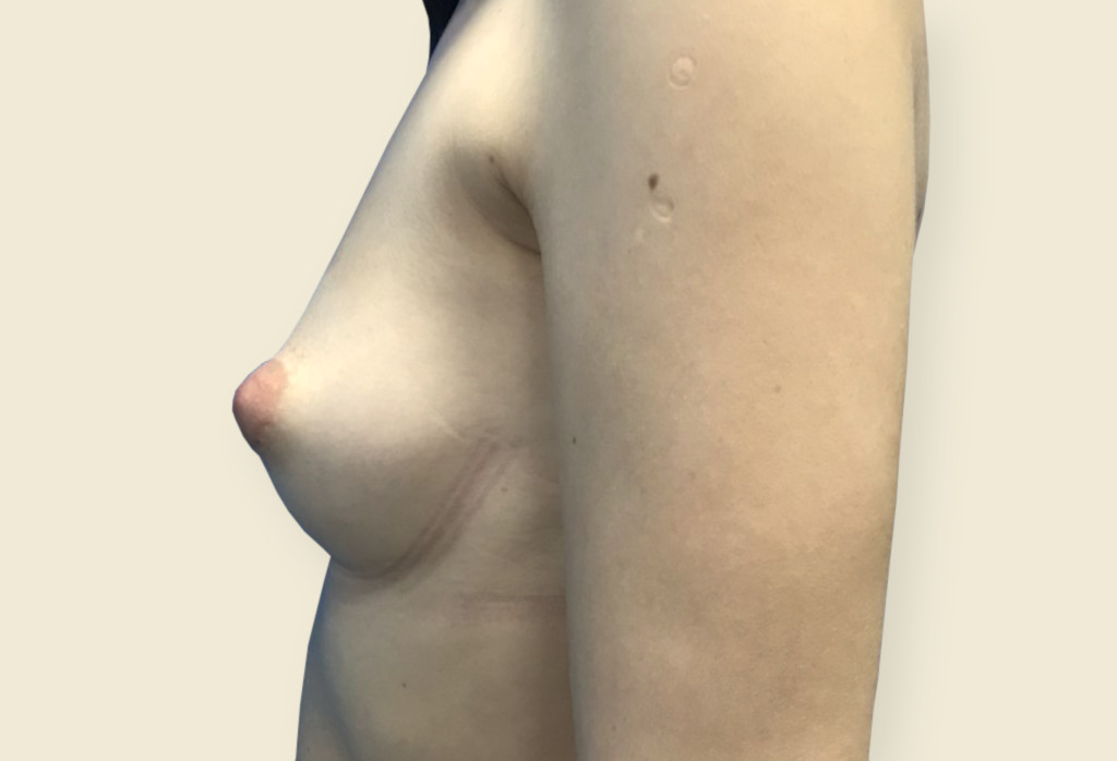 Obecnie asymetria piersi oraz piersi tubularne