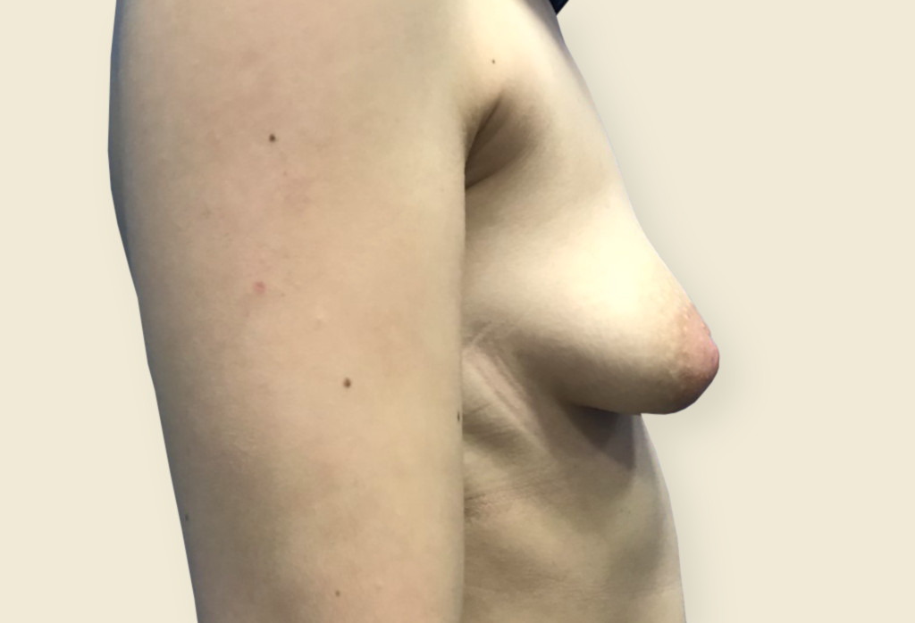 Obecnie asymetria piersi oraz piersi tubularne