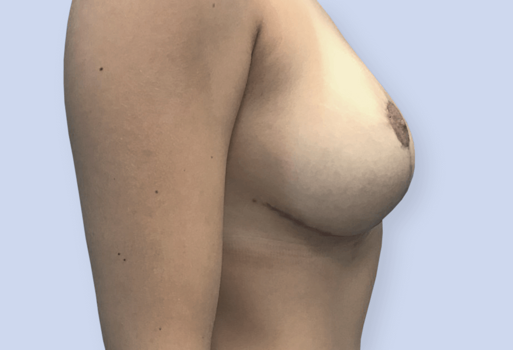 After-Redukcja piersi