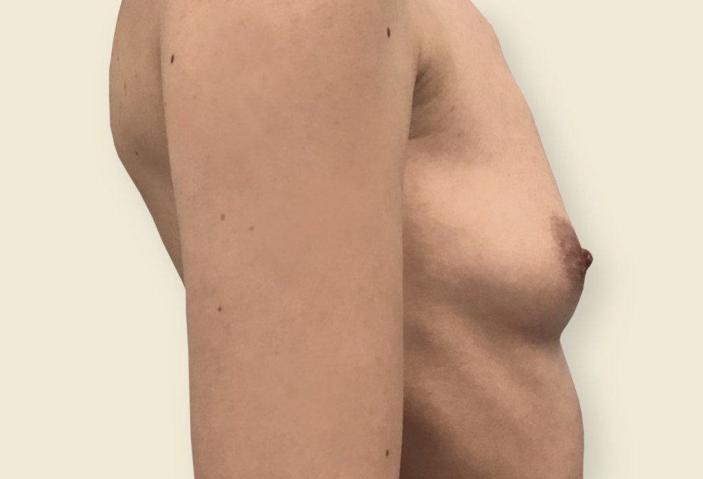 Deformacja klatki piersiowej, zanik gruczołu piersiowego, wciągniecie lewej brodawki sutkowej