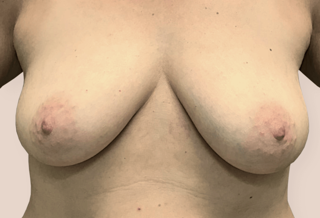 Before-Rekonstrukcja piersi od 6 000 zł