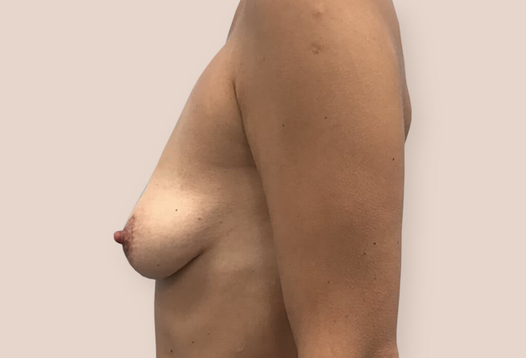 Rekonstrukcja zaniku piersi protezami anatomicznym 260 ml z pozycjonowaniem brodawek sutkowych