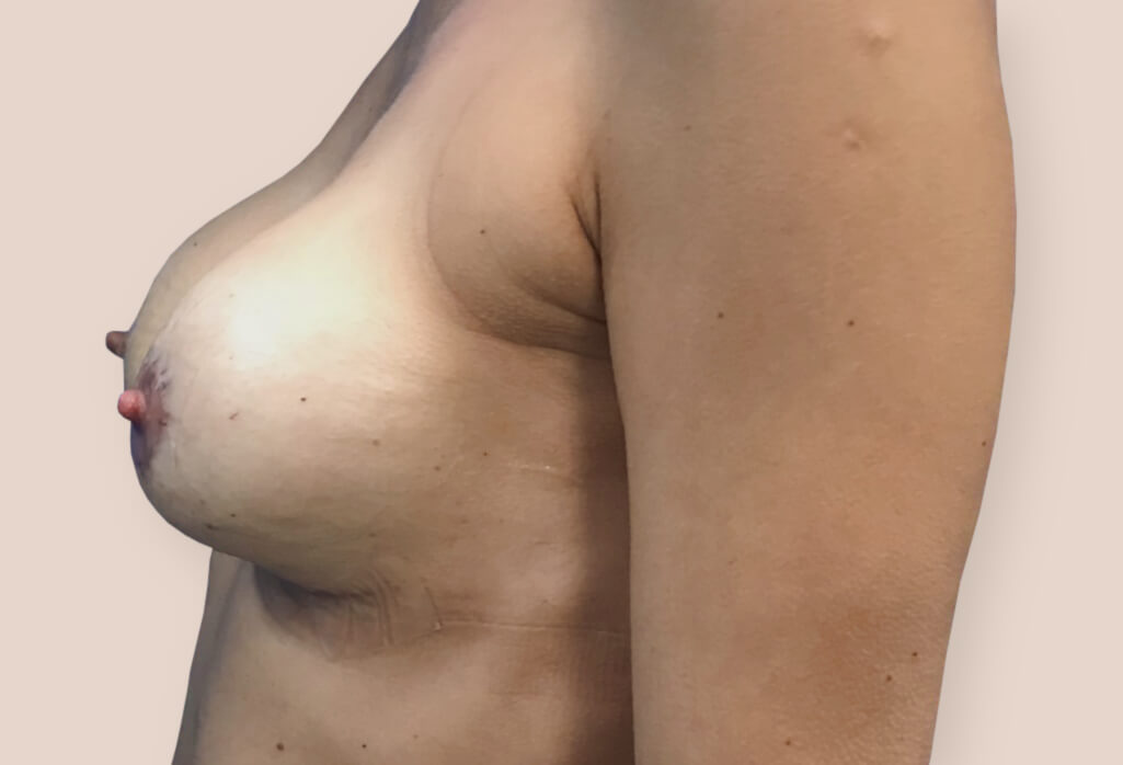 Rekonstrukcja zaniku piersi protezami anatomicznym 260 ml z pozycjonowaniem brodawek sutkowych