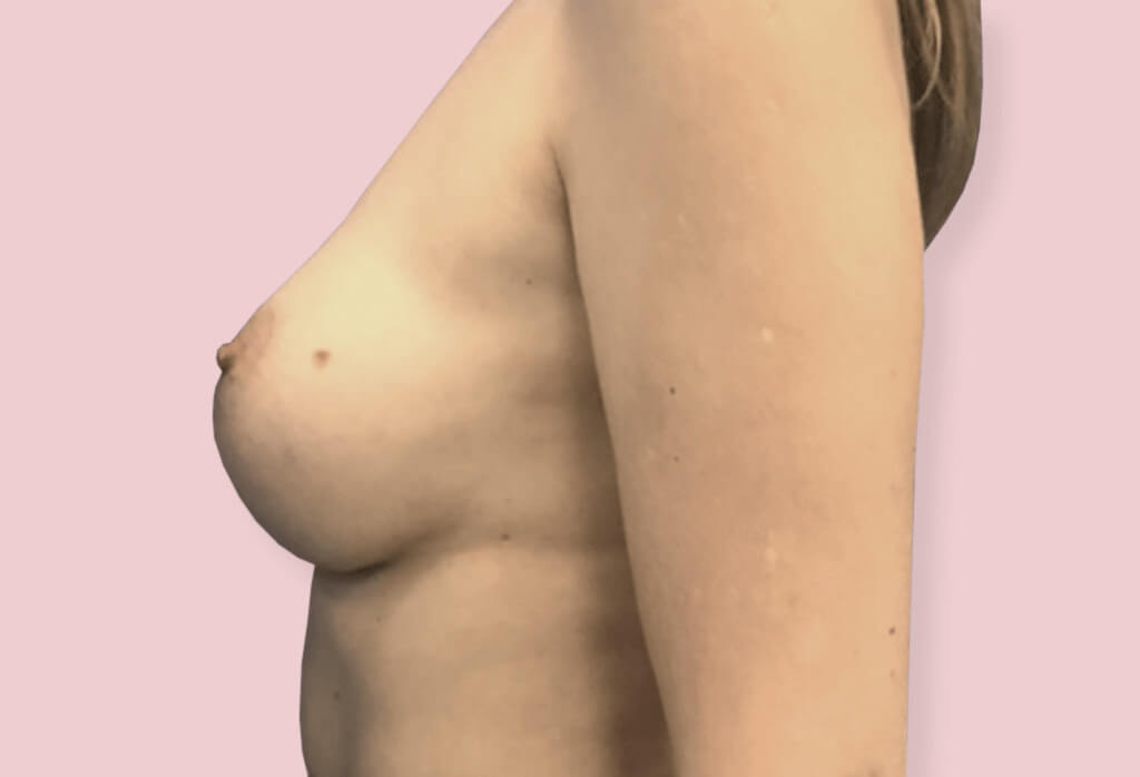 Powiększenie piersi