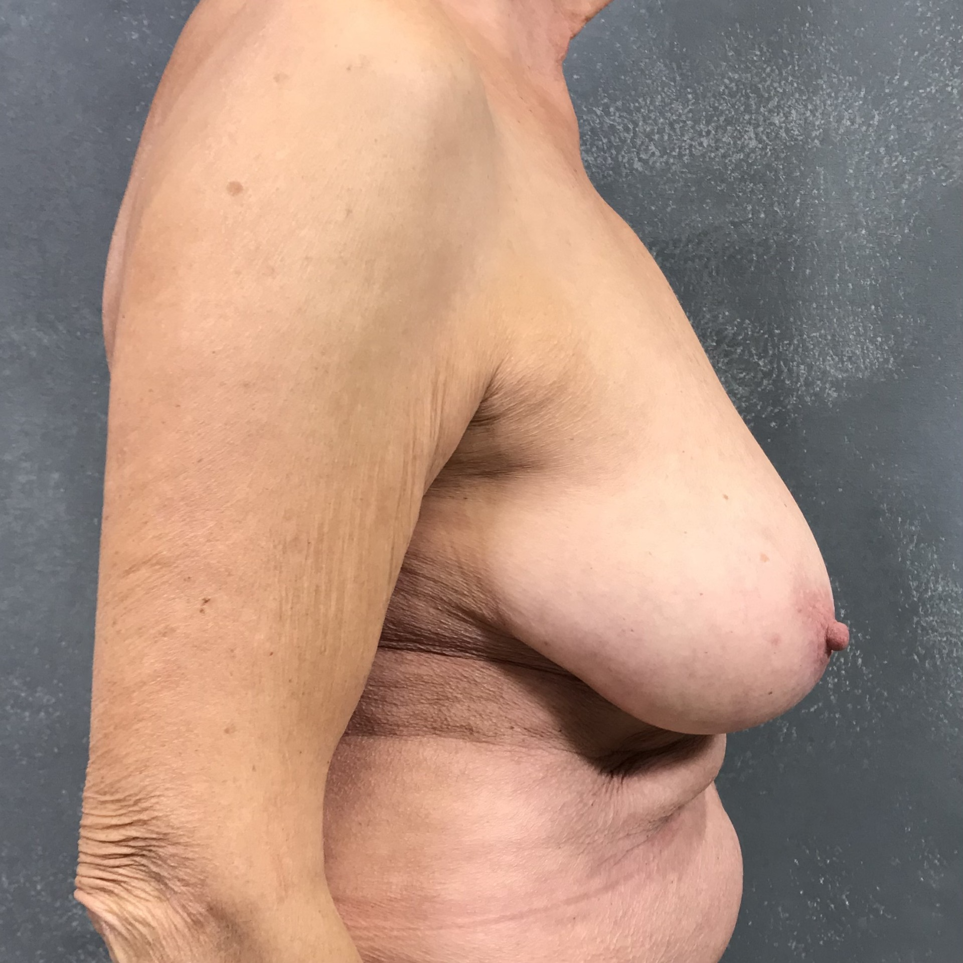 Redukcja piersi — Przed
